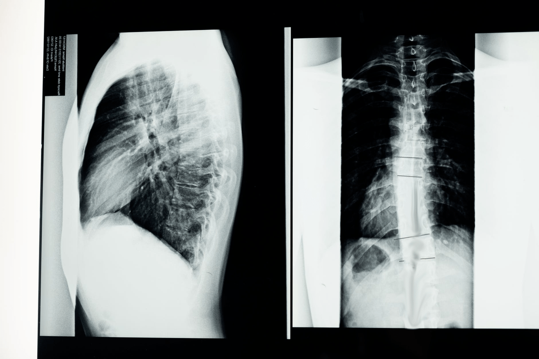 érrendszeri betegek az osteochondrosisban